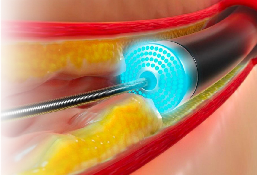 A Guide to Laser Angioplasty: Types, Procedure, Benefits, and Risks